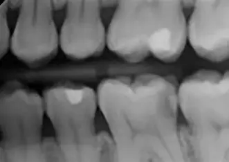 Dental X-Ray (RVG)
